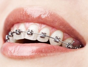 „Straight your teeth“
